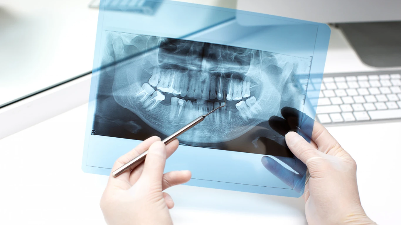 Implantologia dentale ad Ascoli Piceno: soluzioni moderne per ritrovare il sorriso