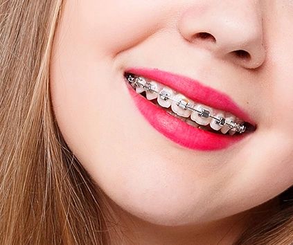 Apparecchio fisso dentale Ascoli Piceno