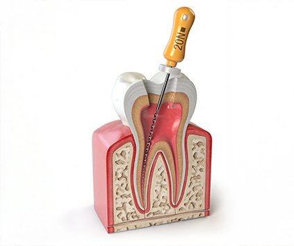 devitalizzazione dente Ascoli Piceno