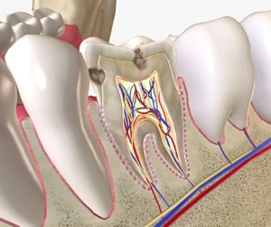 Endodonzia -devitalizzazione del dente Ascoli Piceno