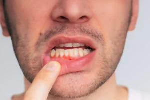 Parodontite Ascoli Piceno