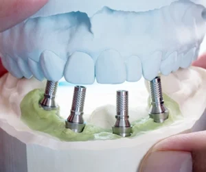 Impianti a carico immediato Ascoli Piceno