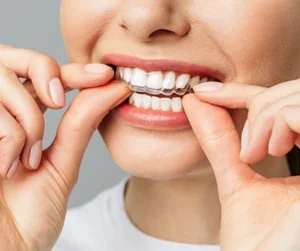 allineatore trasparente - ortodonzia invisibile