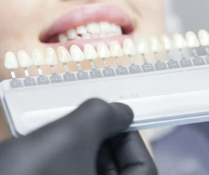 Sbiancamento denti professionale Ascoli Piceno