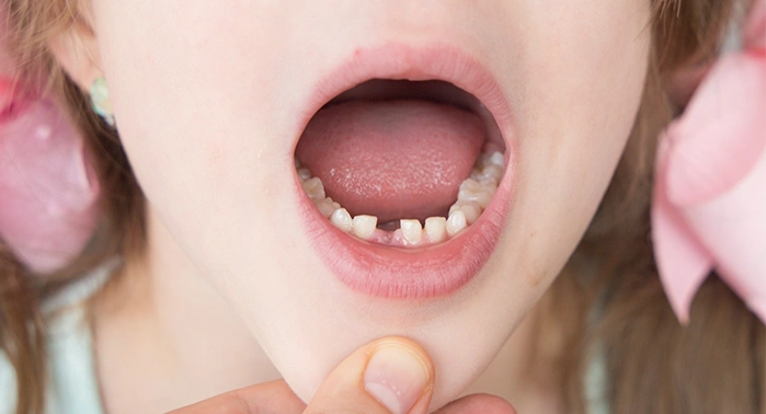 Denti da latte: tutto quello che i genitori dovrebbero sapere