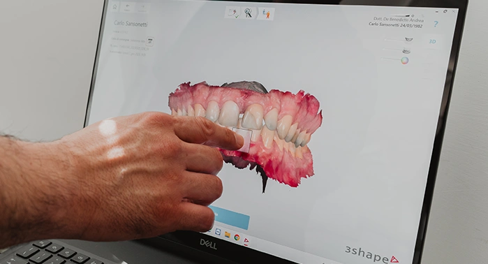 Impronte dentali digitali ad Ascoli Piceno | Scanner 3D – Studio Dott. De Benedictis