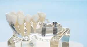 Carico immediato denti ascoli piceno