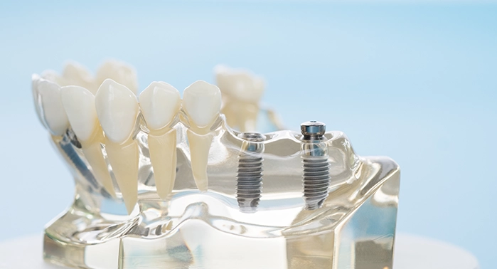 Denti fissi in 24 ore: la rivoluzione del Carico Immediato ad Ascoli Piceno