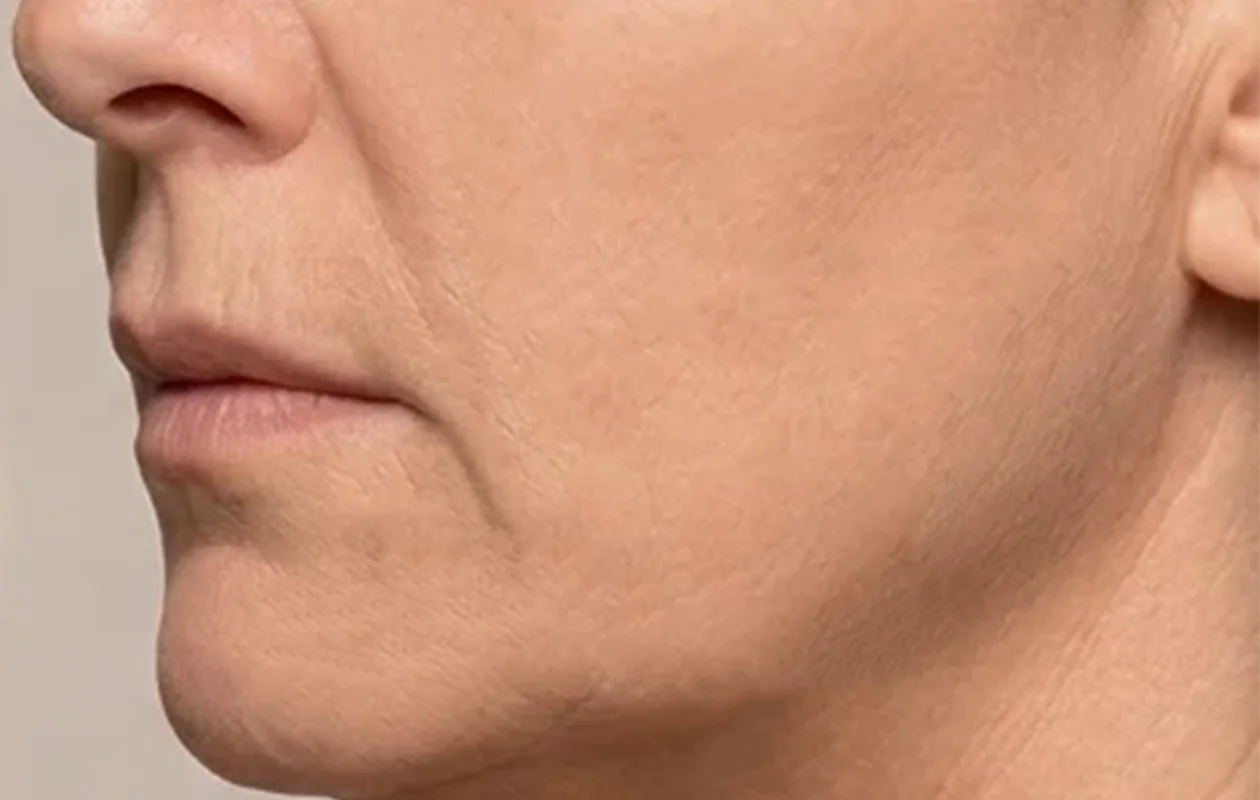 dopo ringiovanimento viso