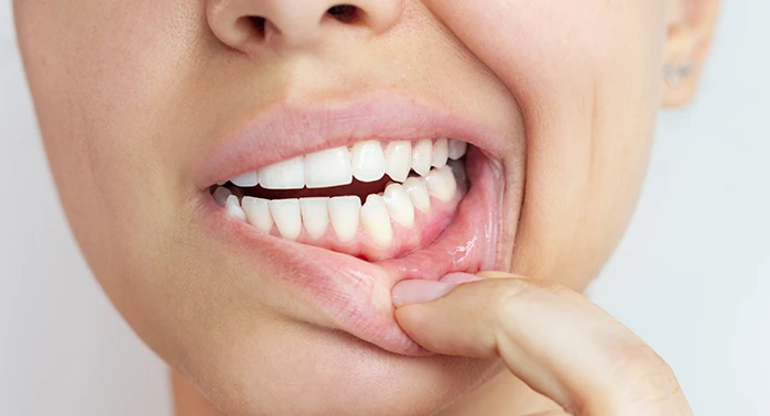 Denti e Cuore: perché la salute delle tue gengive influenza tutto il tuo corpo