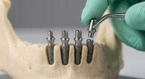 Impianti dentali Ascoli Piceno